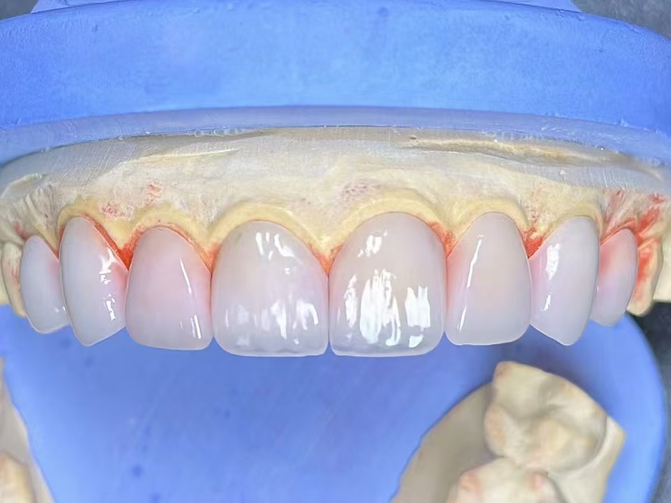 emax-贴面1.jpg